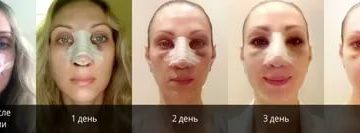 Сколько держится отек после ринопластики