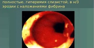 Гиперемирована что это значит