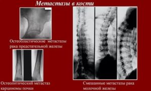 Если метастазы пошли в кости сколько живут