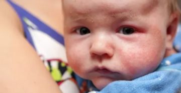 Аллергия у детей до года комаровский Аллергия у детей до года комаровский