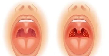 Рыхлые миндалины у ребенка фото