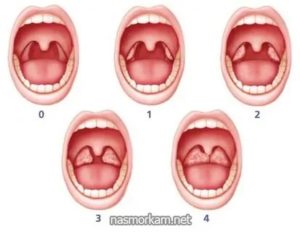Рыхлые миндалины у ребенка лечение