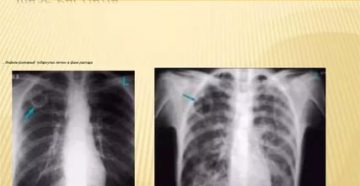 Инфильтративный туберкулёз в фазе распада