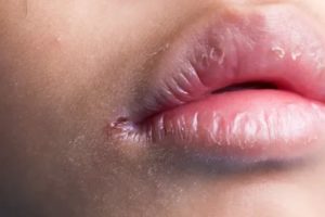 Заеды на губах у ребенка причины лечение