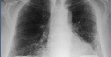 Уплотнение в лёгком что это