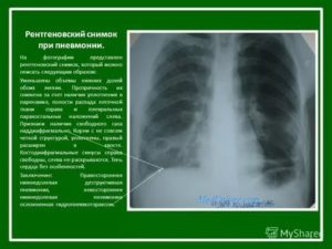 Рентген контроль при пневмонии