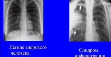 Видно ли на флюорографии что человек курит