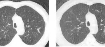Ретенционные кисты легких