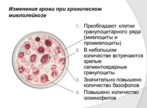 Миелоциты в крови при беременности