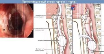 Стеноз трахеи симптомы