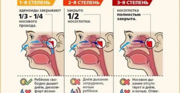 Храп при аденоидах у детей