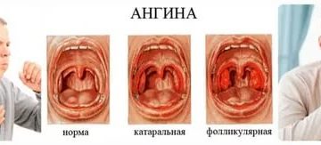 Бывает ли насморк при ангине