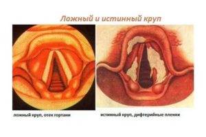 Несмыкание голосовых связок лечение