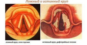 Несмыкание голосовых связок лечение