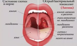 Белые прожилки на миндалинах у ребенка