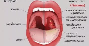 Белые прожилки на миндалинах у ребенка