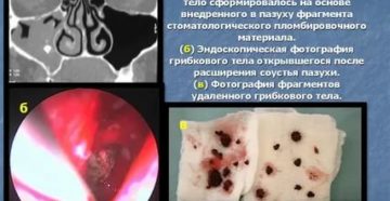 Грибок в гайморовой пазухе