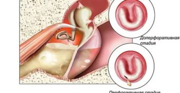 Восстанавливается ли барабанная перепонка