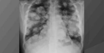 Секундарные изменения в легких