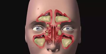 Острый гнойный полисинусит