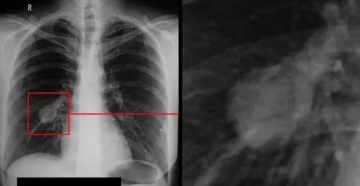 Как обмануть флюорографию