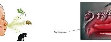 Щекочет в носу и слезятся глаза
