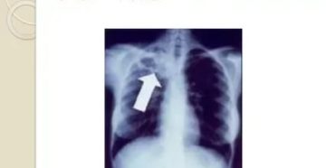 Очаг гона в легких что это