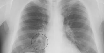 Рентген легких при пневмонии фото
