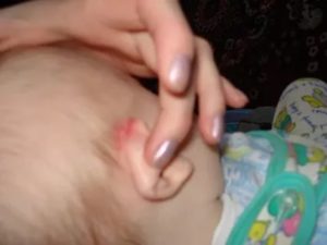 Почему трескается кожа за ушами у ребенка