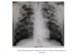Диссеминированный туберкулез легких в фазе инфильтрации