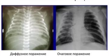 Аспирация легких у новорожденных