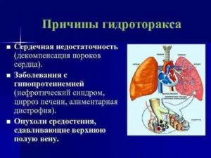 Правосторонний гидроторакс причины