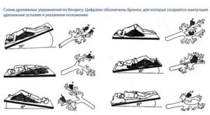 Дренажные упражнения при заболеваниях органов дыхания