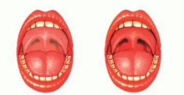 Красная задняя стенка горла у ребенка Красная задняя стенка горла у ребенка