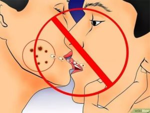 Заразен ли герпес на губах при поцелуи