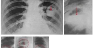 Абсцесс легкого рентгенограмма