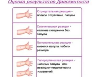 Можно ли делать диаскинтест при кашле