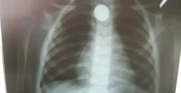 Инородное тело в легких у ребенка симптомы Инородное тело в легких у ребенка симптомы