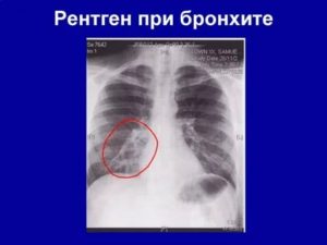 Рентген при бронхите у детей