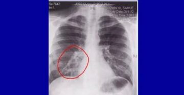 Рентген при бронхите у детей Рентген при бронхите у детей