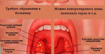 Почему не проходит ангина после антибиотиков