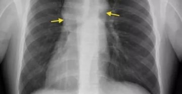 Аденопатия что это такое