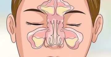 Катаральный полисинусит