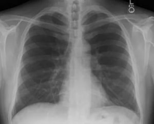 Пневмония фото рентген до и после