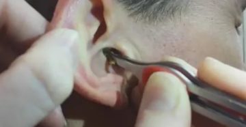 Черная сера в ухе у ребенка Черная сера в ухе у ребенка