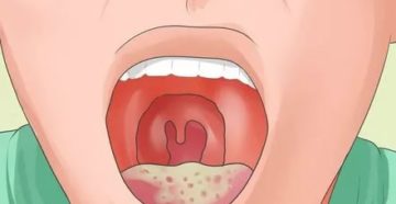 Инфекции полости рта симптомы