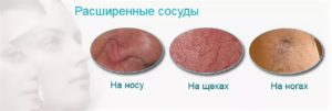 Расширенные сосуды в носу