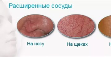 Расширенные сосуды в носу