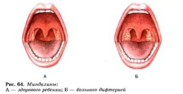 Зев гиперемирован что значит
