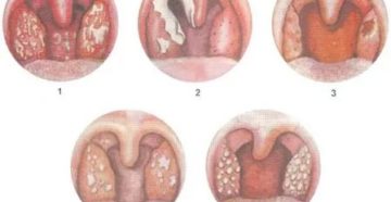 Стрептококковая ангина у детей
